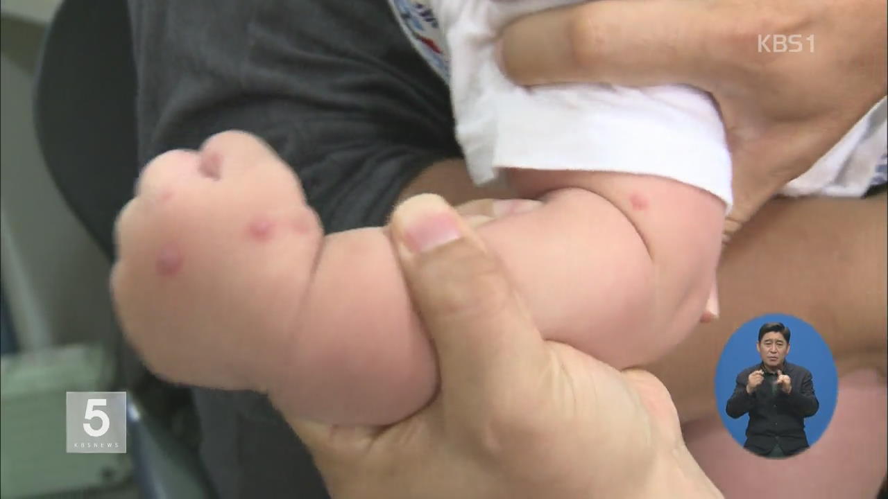 수족구병 의심환자, 한 달 새 3배↑…대유행 우려