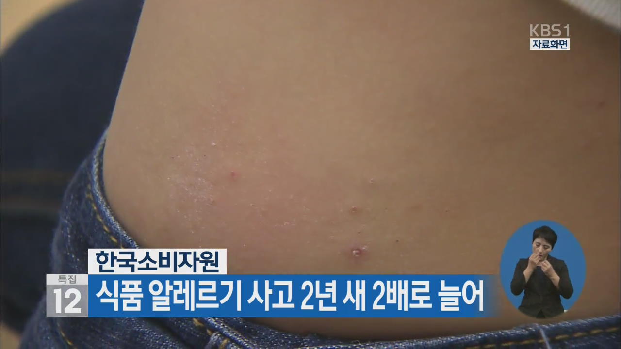 소비자원, 식품 알레르기 사고 2년 새 2배로 늘어